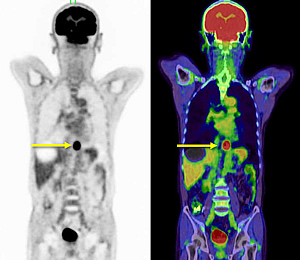 PET 冠状断（右） PET-CT冠状断（左）