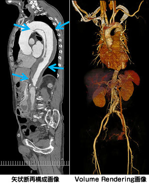 大動脈解離の造影CT