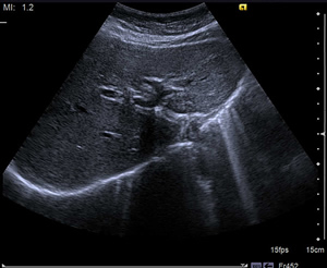 腹部超音波正常例