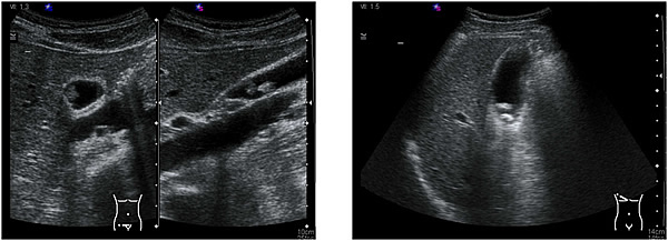 腹部超音波　胆嚢ポリープ（左）と胆石（右）