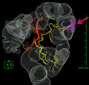 WSを用いて作成した大腸がん術前の3D-CT