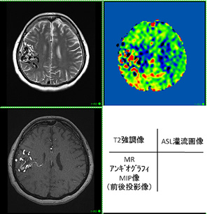 脳動静脈奇形 Brain arteriovenous malformation