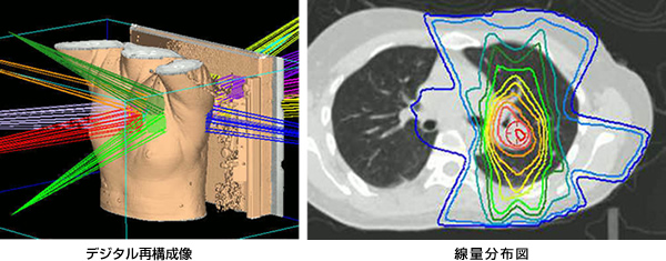 転移性肺がんの症例：放射線治療計画