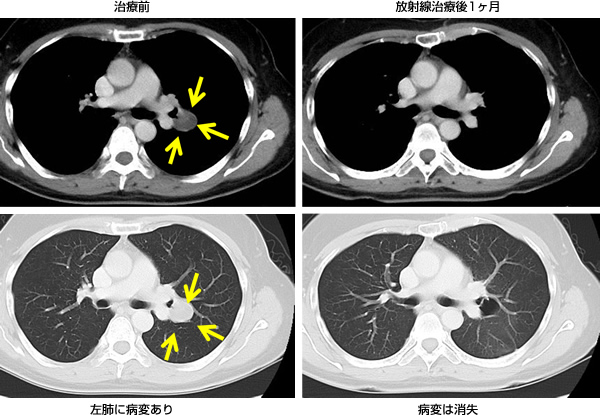 転移性肺がんの症例：CT画像